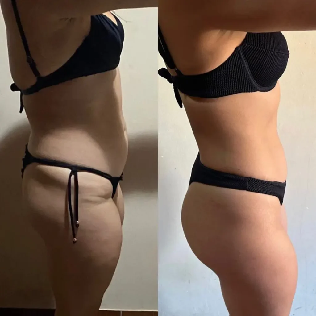 Antes e Depois 03 mulher